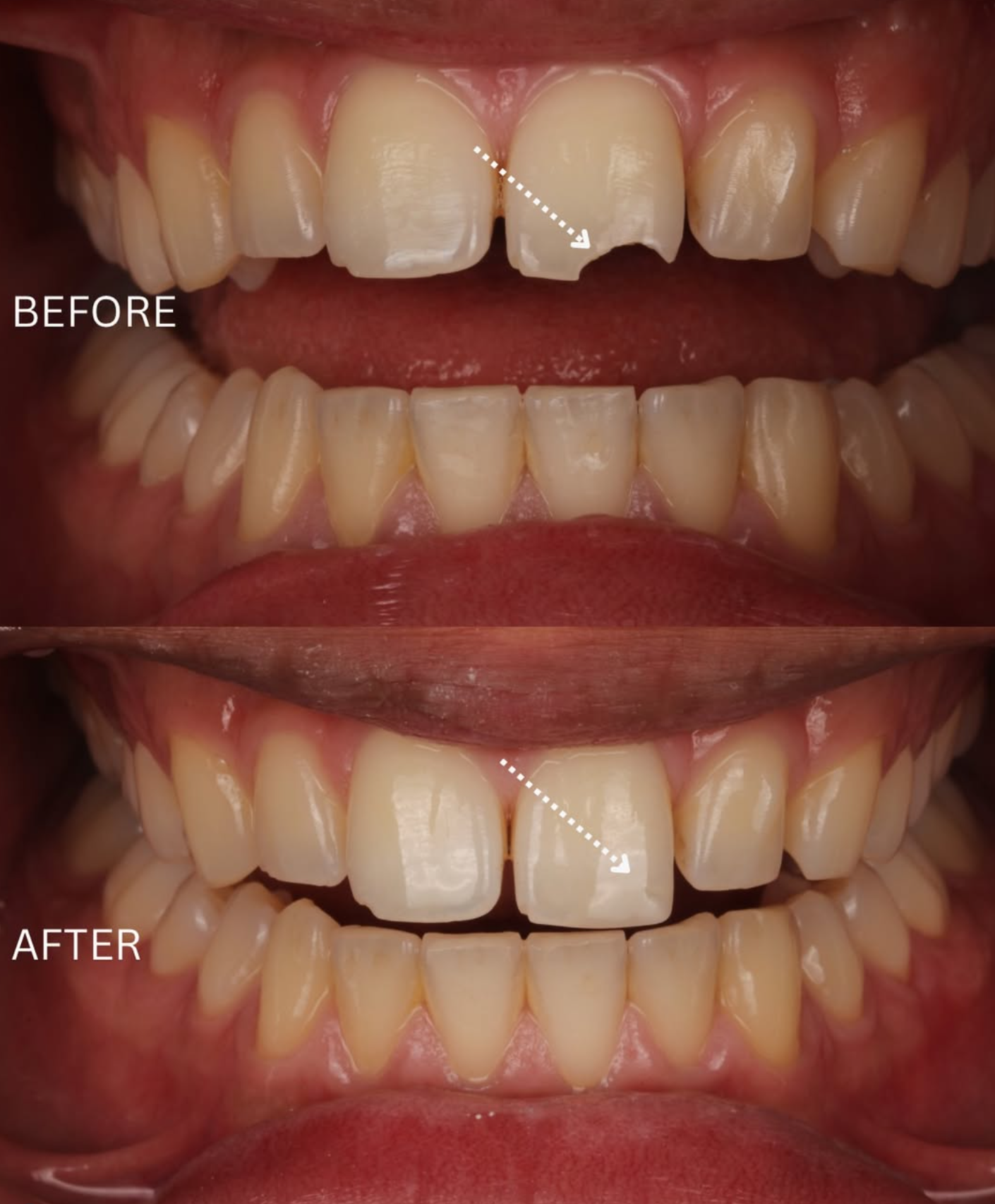 Before and after: Chipped front tooth restoration