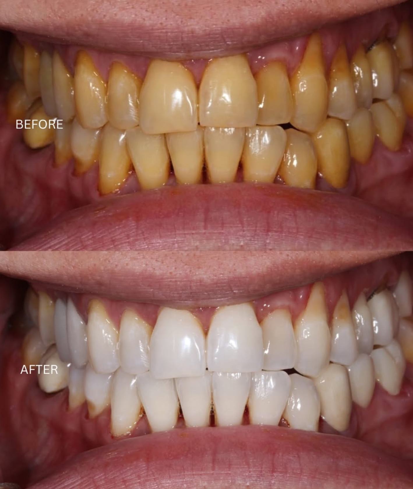 Before and after: Full smile whitening