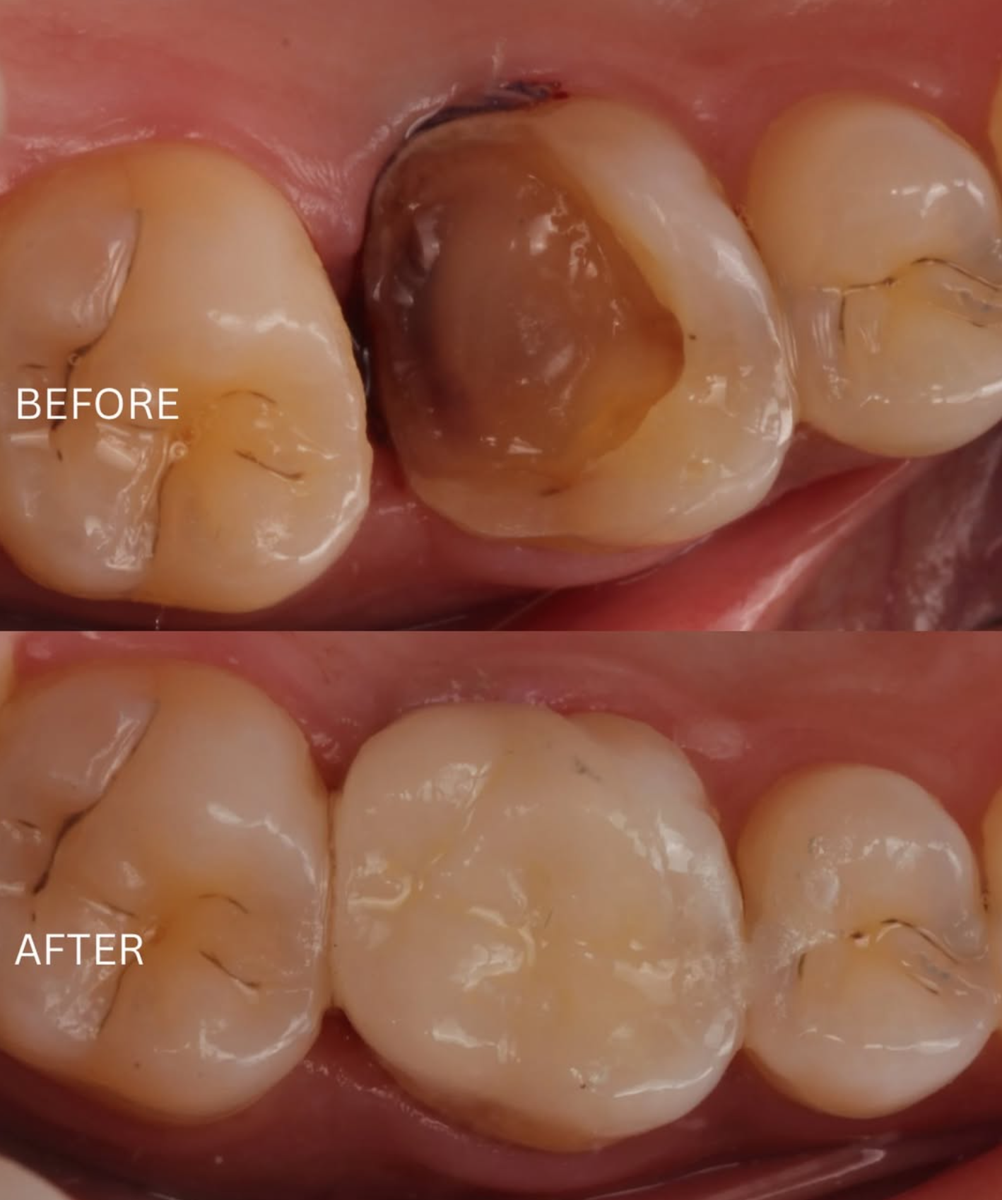 Before and after: Molar ceramic restoration